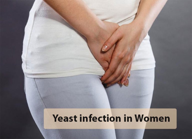 Vaginal Yeast Infection, Trend Health