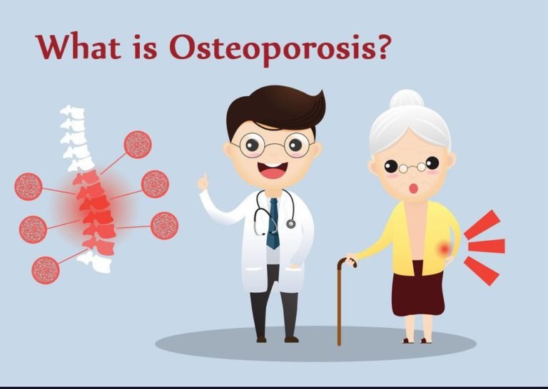 What is Osteoporosis? Symptoms, Causes and Treatment