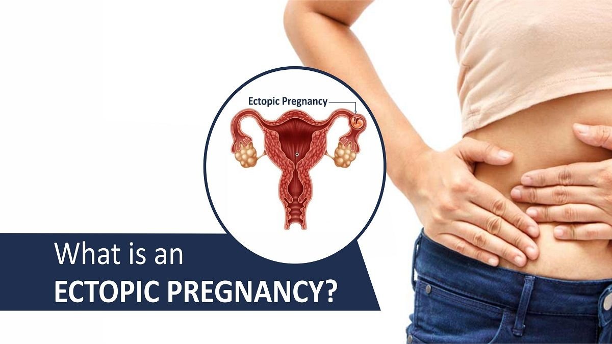 What is an ectopic pregnancy?, Trend Health