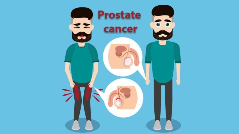 What is Prostate Cancer? Symptoms, treatment, and causes