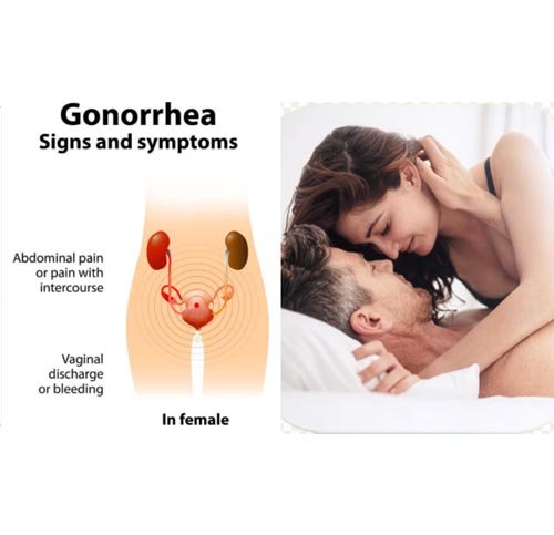 What is Gonorrhea, trend health