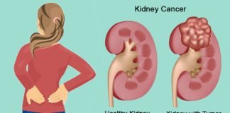 Kidney Cancer Symptoms, trend health