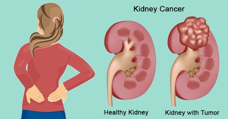 Kidney Cancer Symptoms, trend health