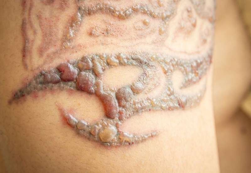 Permanent Tattoo, Tattoo Allergic reactions, Trend Health