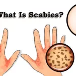 What Is Scabies?, Trend Health