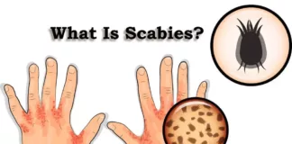 What Is Scabies?, Trend Health