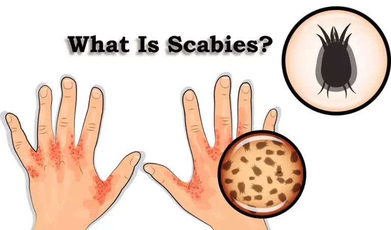 What Is Scabies? Symptoms, Facts and Treatment