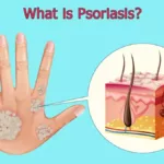 What is Psoriasis?, Trend Health