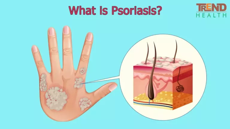 What is Psoriasis?, Trend Health