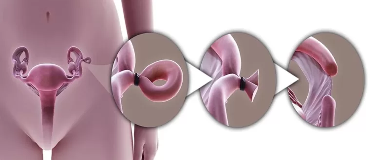 Ligation Surgery, Trend Health