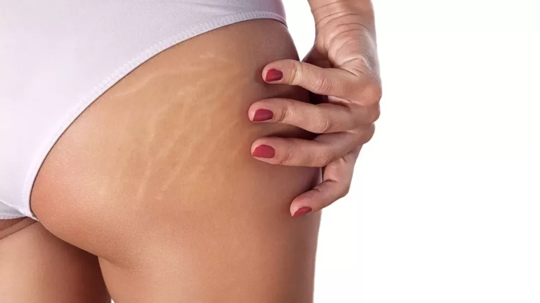 Reducing Stretch Marks, Trend Health