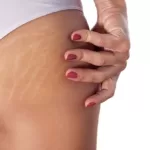 Reducing Stretch Marks, Trend Health