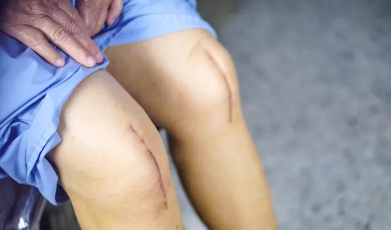 Knee Replacement, Trend Health