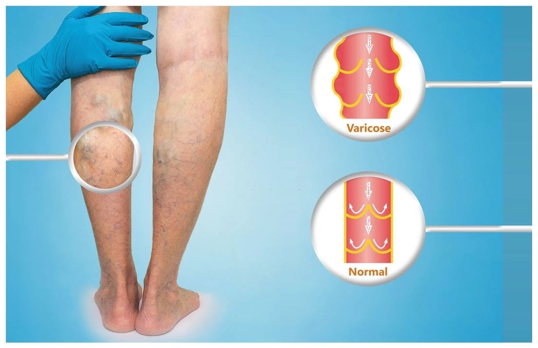 Unsightly Veins, Trend Health