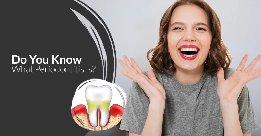 What is Periodontitis?, Trend Health