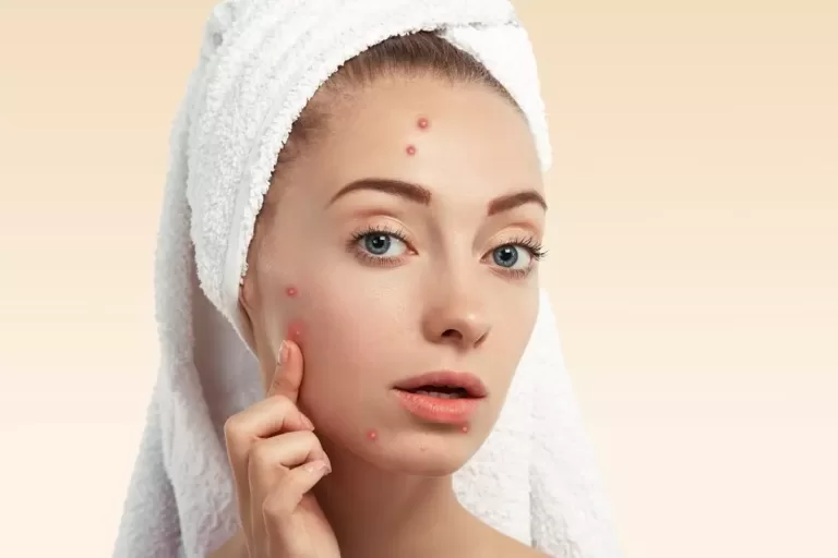 Fungal Acne, Trend Health