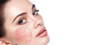 Know About Rosacea, Trend Health