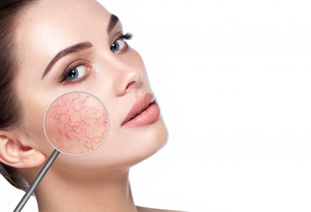 Know About Rosacea, Trend Health