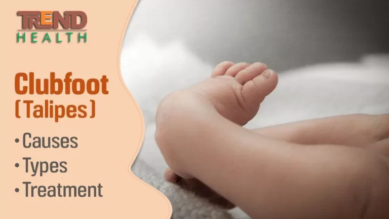About Clubfoot, Trend Health