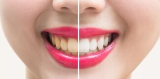 Yellow Teeth, Trend Health