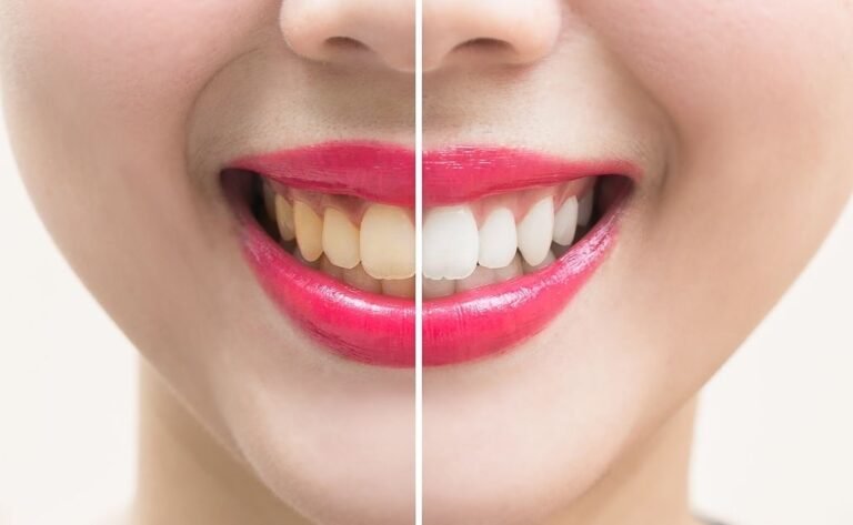 Yellow Teeth, Trend Health