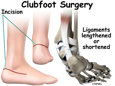 Diagnosis of Clubfoot