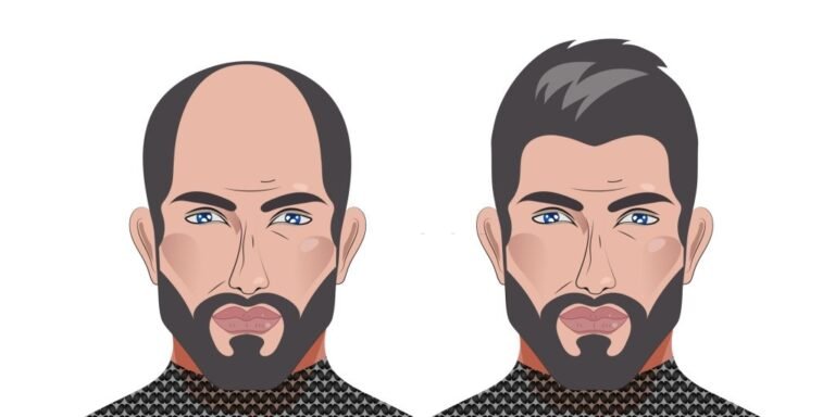 Best Hair Transplant, Trend Health