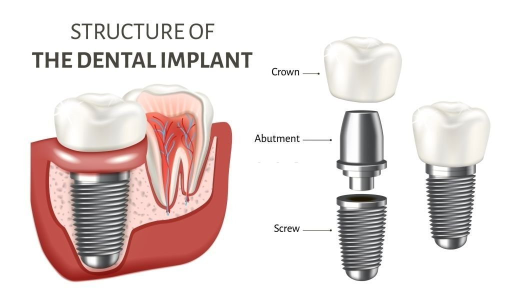 Dental Implants