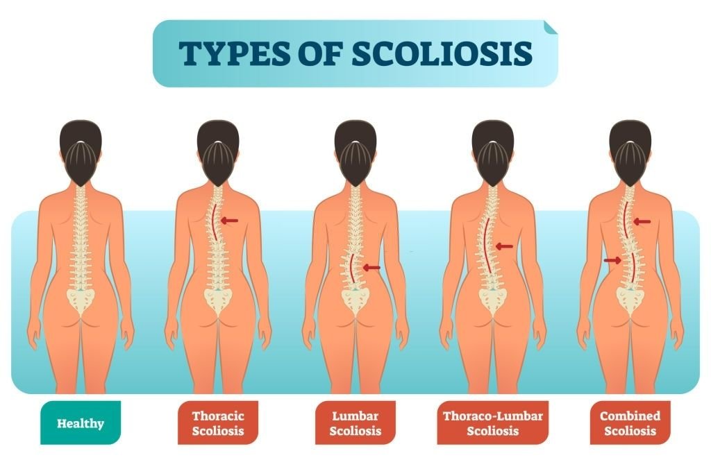 Scoliosis