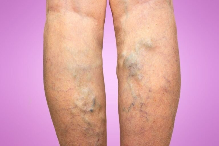 Considering Vein Removal? Read This Before!
