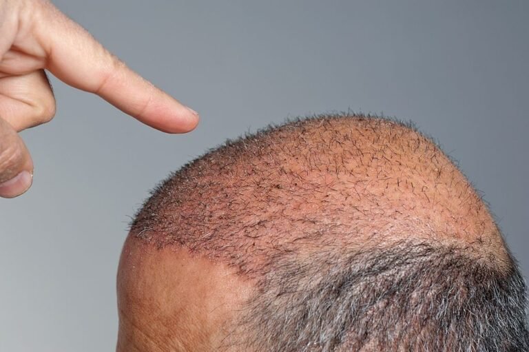 Dr. Mohit Srivastava Is Here To Fix Your Wrong Hair Transplant!