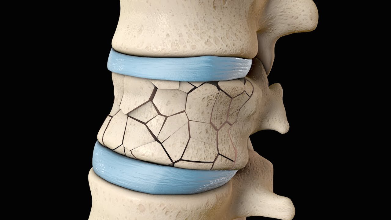 Compression Fracture