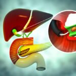 Gallstones (Cholelithiasis)