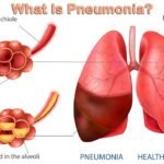 What Is Pneumonia