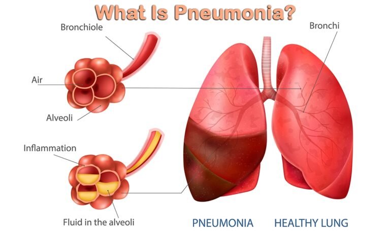 Pneumonia: Causes, Symptoms & Treatment
