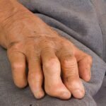 What is Leprosy