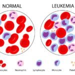 Leukemia (Blood Cancer) Symptoms, Causes & Treatment