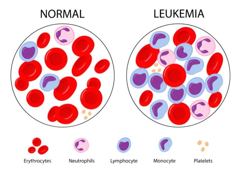 Leukemia (Blood Cancer): Symptoms, Causes & Treatment