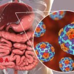 What is Hepatitis A