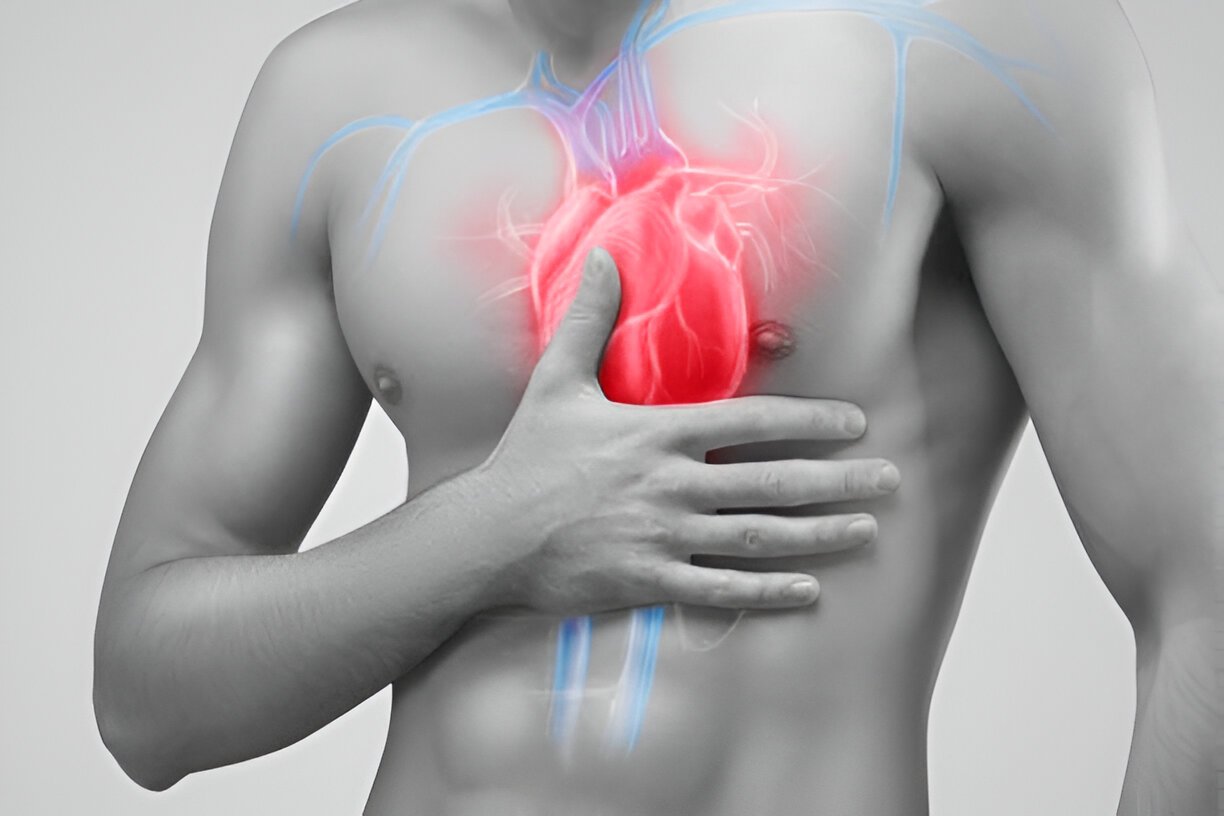 Myocardial Infarction