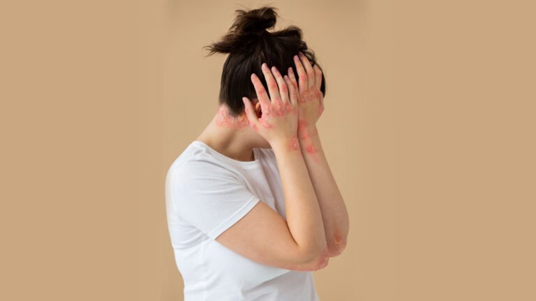 Can Natural Supplements Help Manage Lupus Symptoms